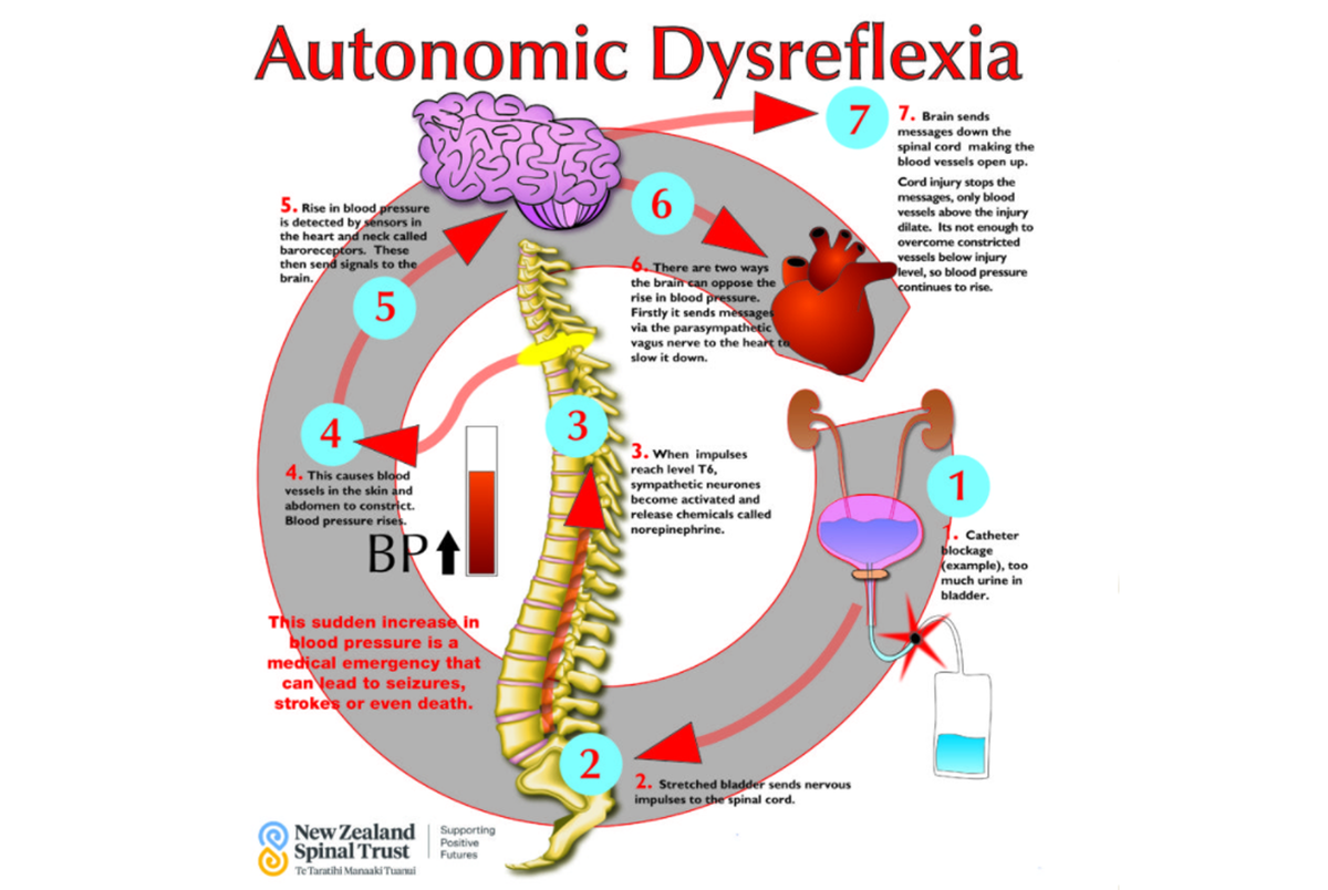 Autonomic dysreflexia poster